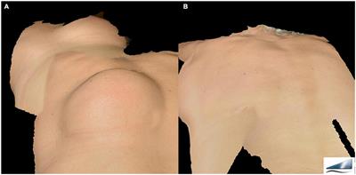 Lipoma management with a minimally invasive 1,444 nm Nd:YAG laser technique